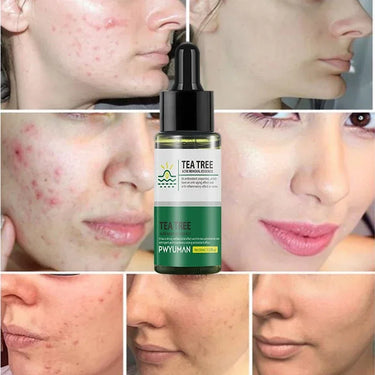 Benefits of tea tree serum for acne