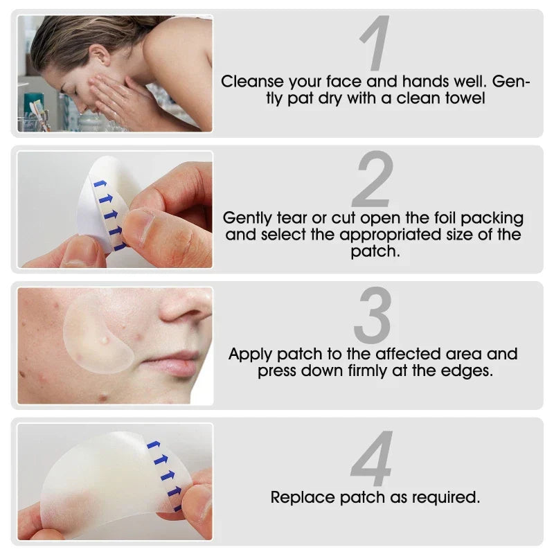 Hydrocolloid pimple patches for acne treatment