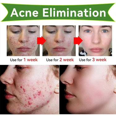 How to use tea tree serum for acne removal effectively