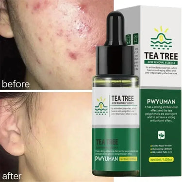 Tea tree oil for acne-prone skin