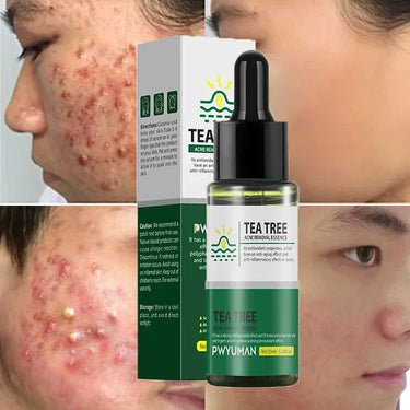 Benefits of tea tree oil serum for acne and scars