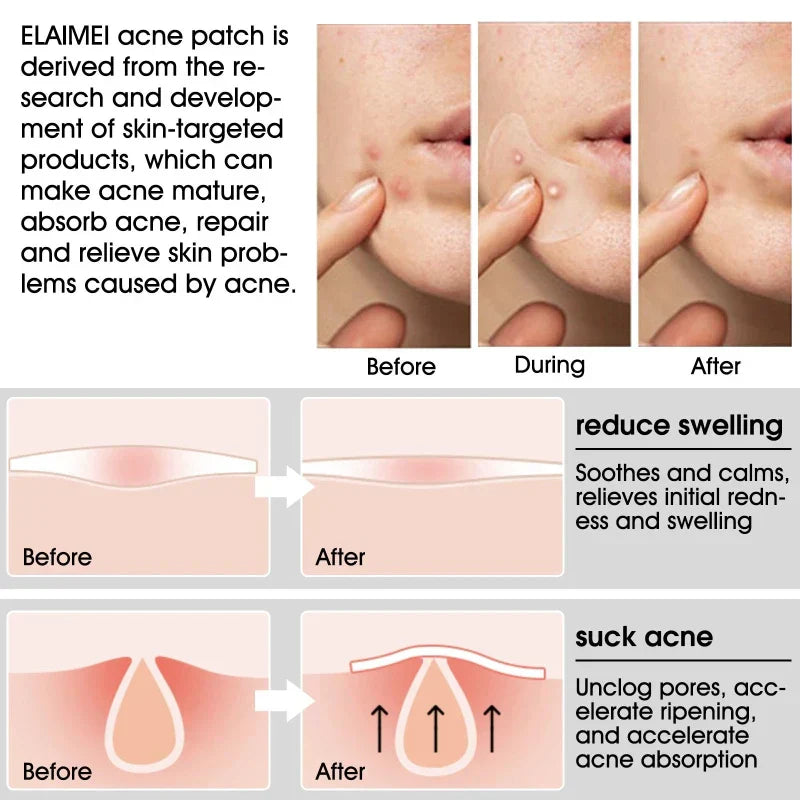 Absorbing spot treatment hydrocolloid dressing