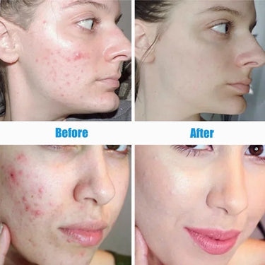 Does tea tree serum help with acne scars